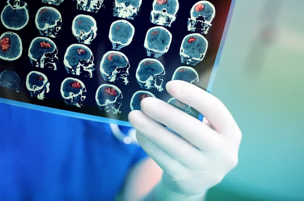 Hyperbaric Oxygen Therapy for Stroke Recovery: A Revolutionary Approach